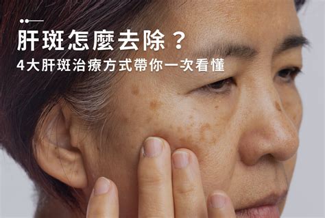 臉頰長斑|一次解析曬斑、肝斑、雀斑、顴骨母斑等皮膚黑斑原因…